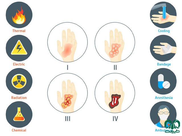 سوختگی بر اساس شدت آن 
