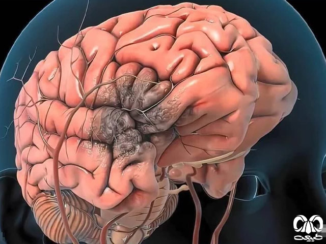 خونریزی از جمجمه و گوش بر اثر ضربه به سر خونریزی از جمجمه و گوش